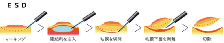 ③ESD（内視鏡的粘膜下層剥離術）