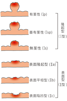 内視鏡治療