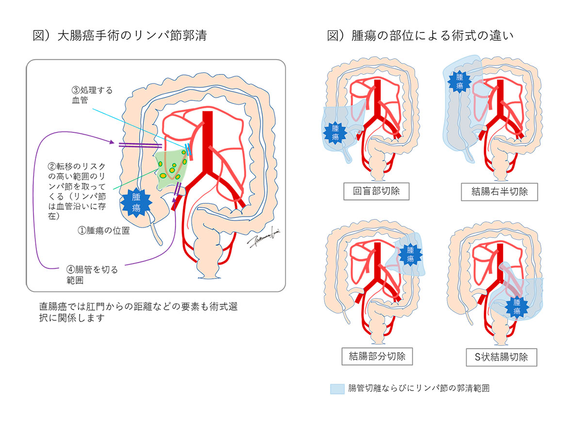 盲腸がんの外科手術「回盲部切除術」