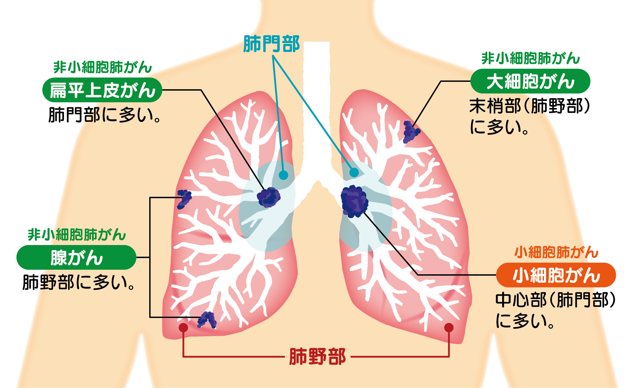 肺腺がんとは