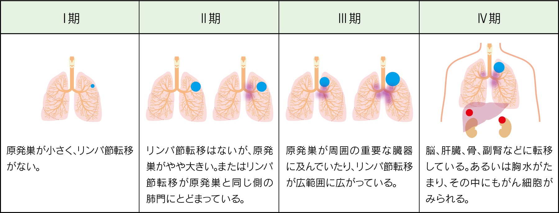 肺腺がんのステージ分類