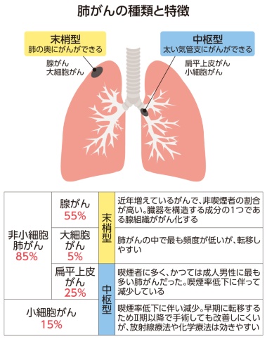 小細胞肺がんとは