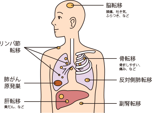 小細胞肺がんの進行時のサイン
