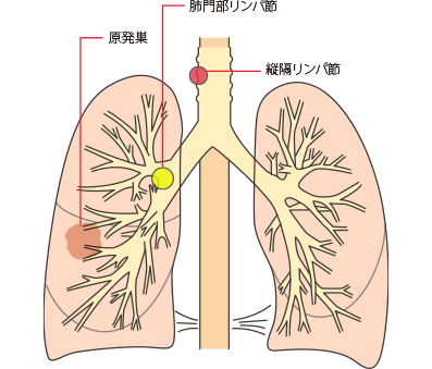 肺がんステージ3とはどのような状態か1