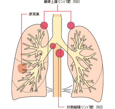 肺がんステージ3とはどのような状態か2