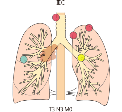 肺がんステージ3とはどのような状態か3