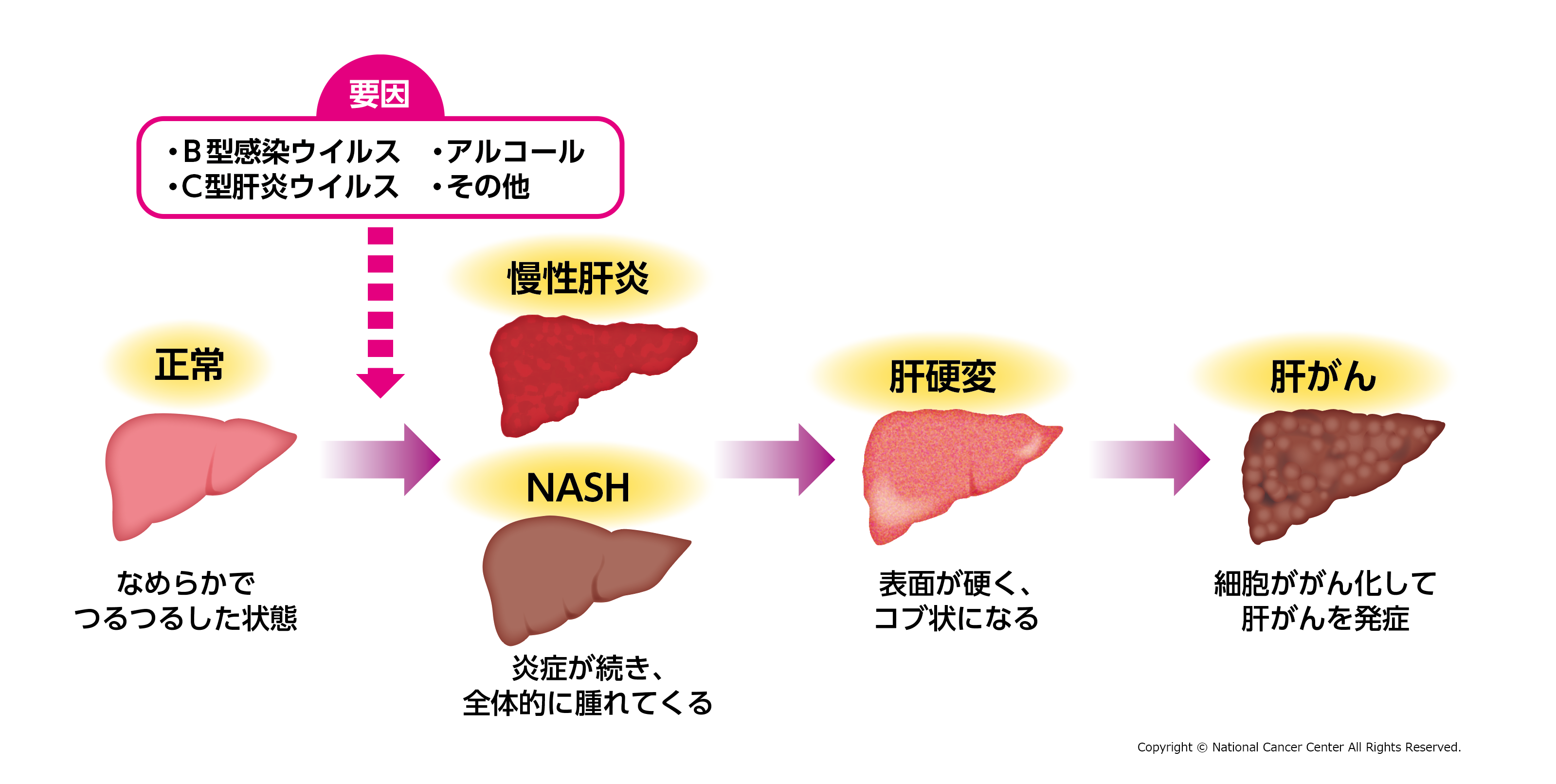 肝臓がんになるまでの経過