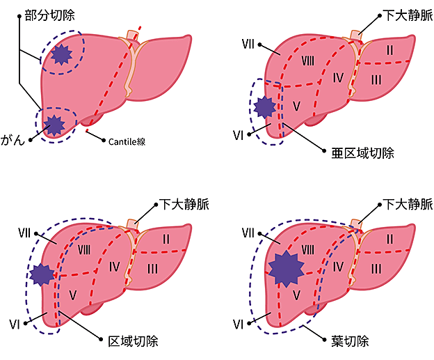 肝臓がんの手術