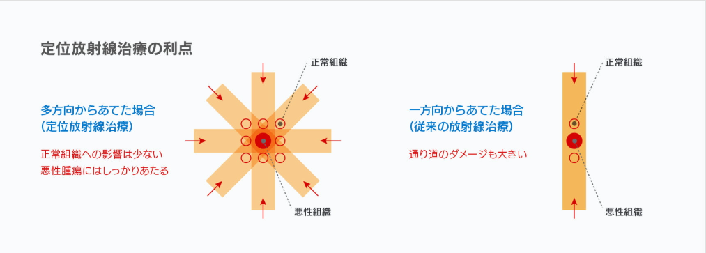 放射線治療・定位放射線治療(SBRT)
