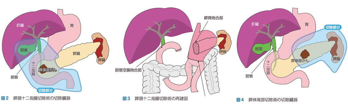 膵臓がんの手術と術式