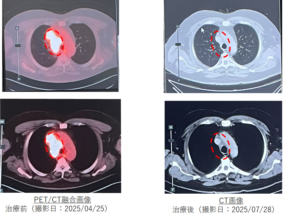 治療前後のPET-CTおよびCT画像比較（小細胞肺がん・縦隔リンパ節領域）