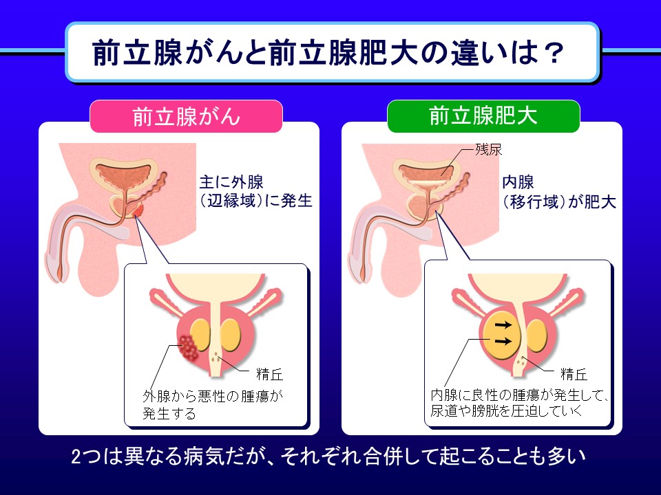 前立腺肥大症との違いは?