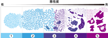 グリソンスコア1