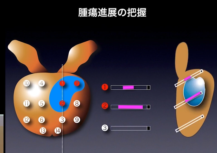 グリソンスコア2