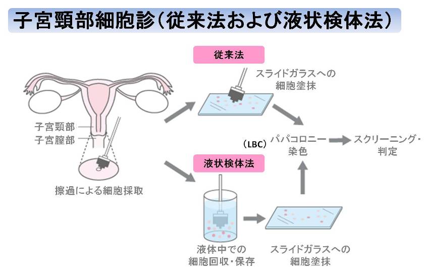 子宮頸がん検診は月経中はできるだけ避ける