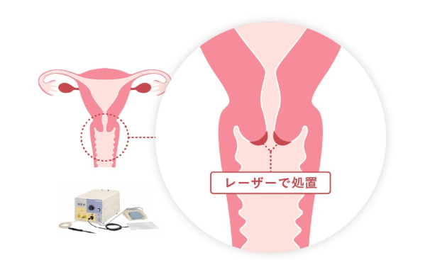 レーザー蒸散術