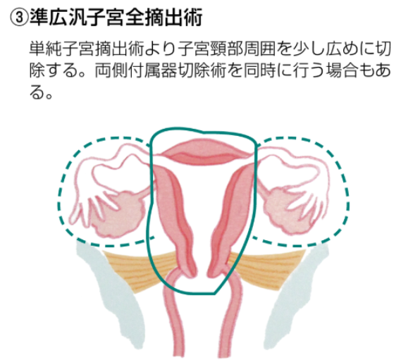 準広汎子宮全摘出術