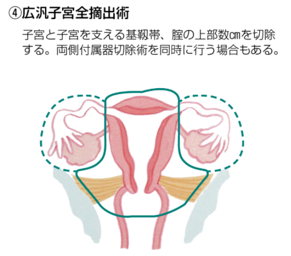 広汎子宮摘出術