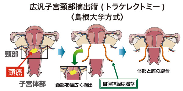 広汎子宮頸部摘出術