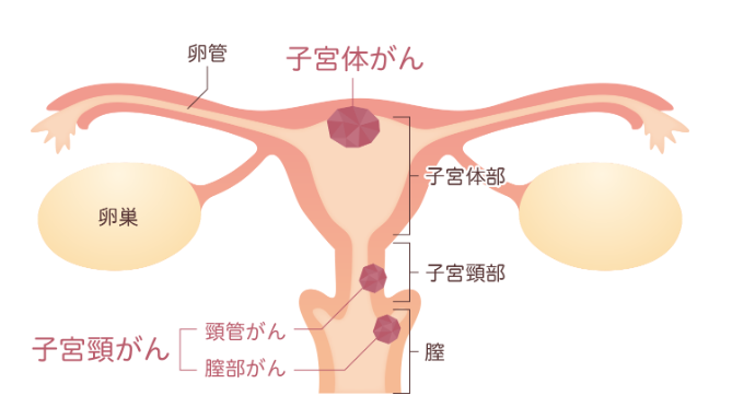 子宮体がんとは