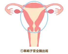 単純子宮全摘出術1