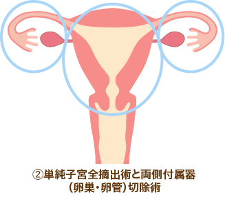 単純子宮全摘出術2