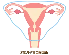 広範囲子宮全摘出術