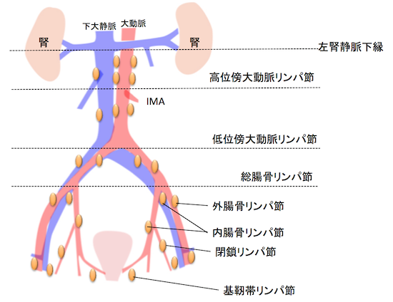 リンパ節郭清術