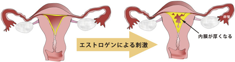 エストロゲンによる子宮内膜への刺激