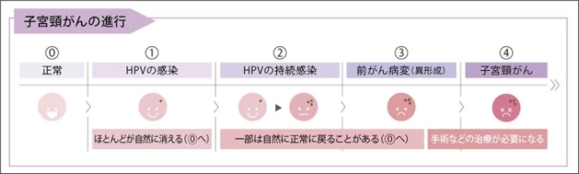 子宮頸がんワクチンは原因になるウイルス感染を予防する