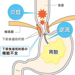 逆流性食道炎とは