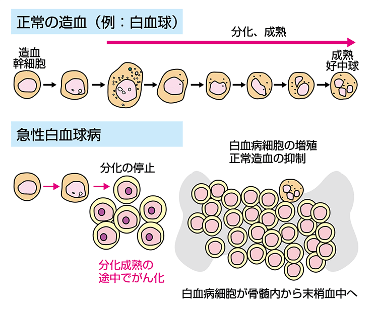 急性リンパ性白血病（ALL）とは