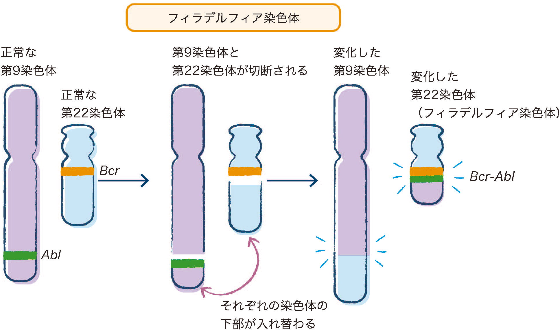 急性リンパ性白血病（ALL）の原因