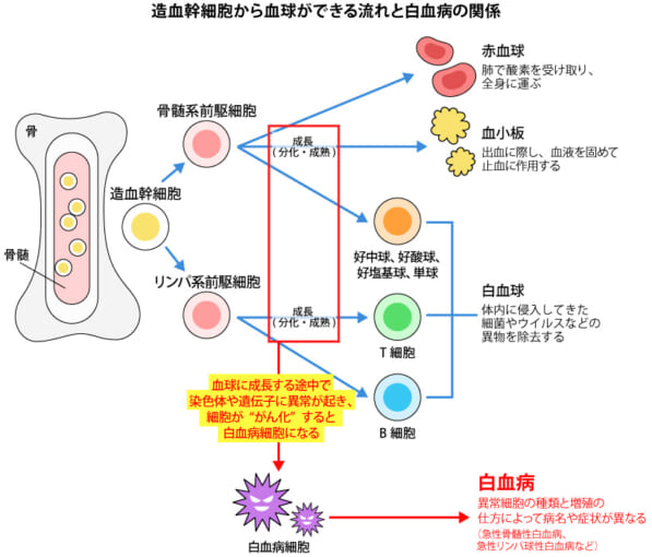 白血病の種類ごとの血液検査の特徴