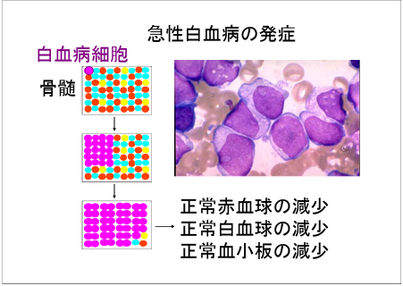 急性リンパ性白血病（ALL）