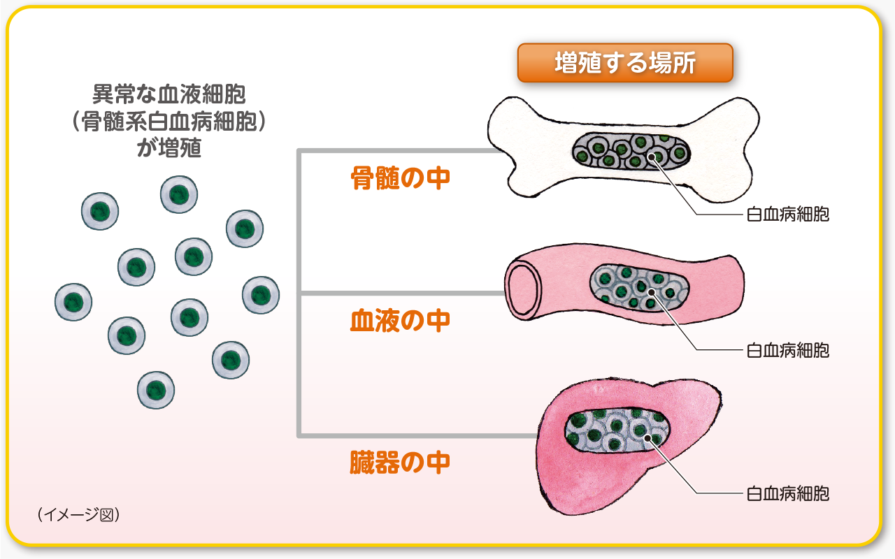 急性骨髄性白血病（AML）