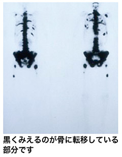 骨シンチグラフィー