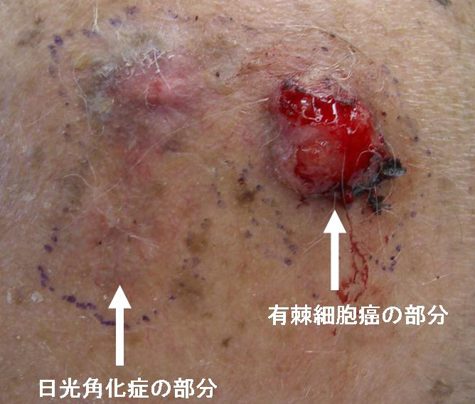有棘（ゆうきょく）細胞がん1