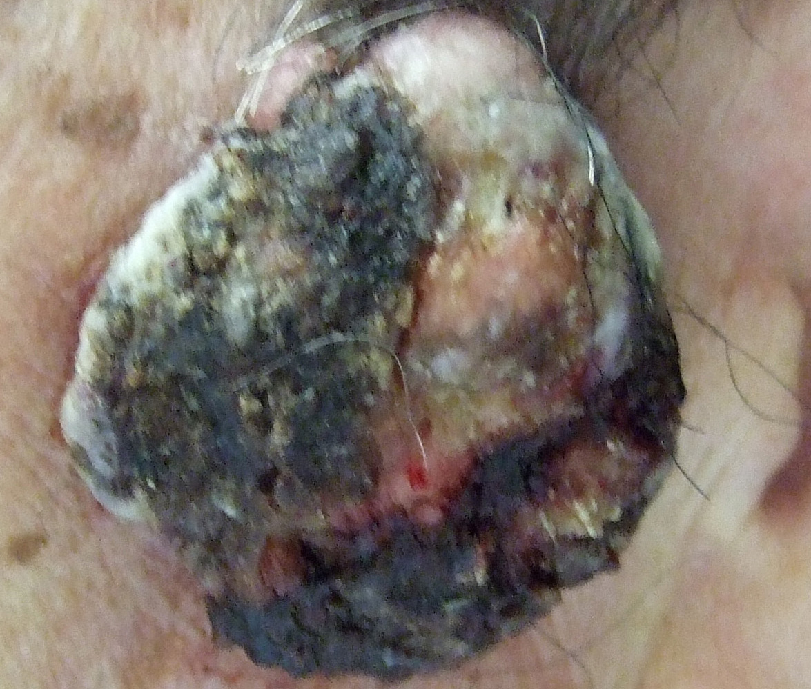 有棘（ゆうきょく）細胞がん2