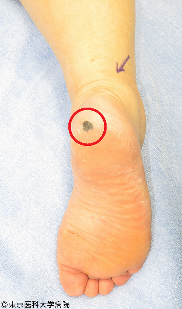 悪性黒色腫・メラノーマ1