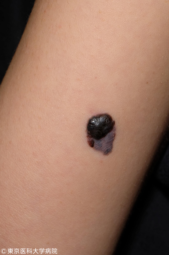 悪性黒色腫・メラノーマ2