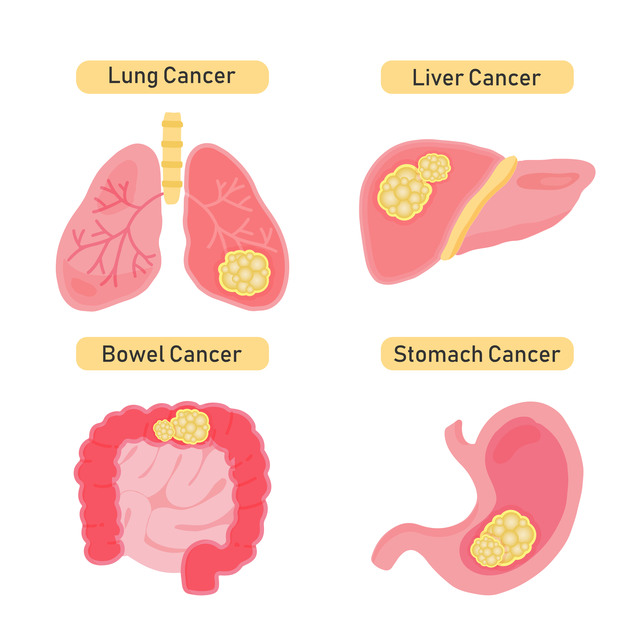 がんは2種類に分けられる　それぞれの特徴や治療法について