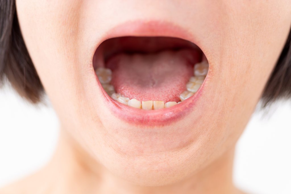 中咽頭がんとは？原因・症状・治療・予後・予防まで徹底解説