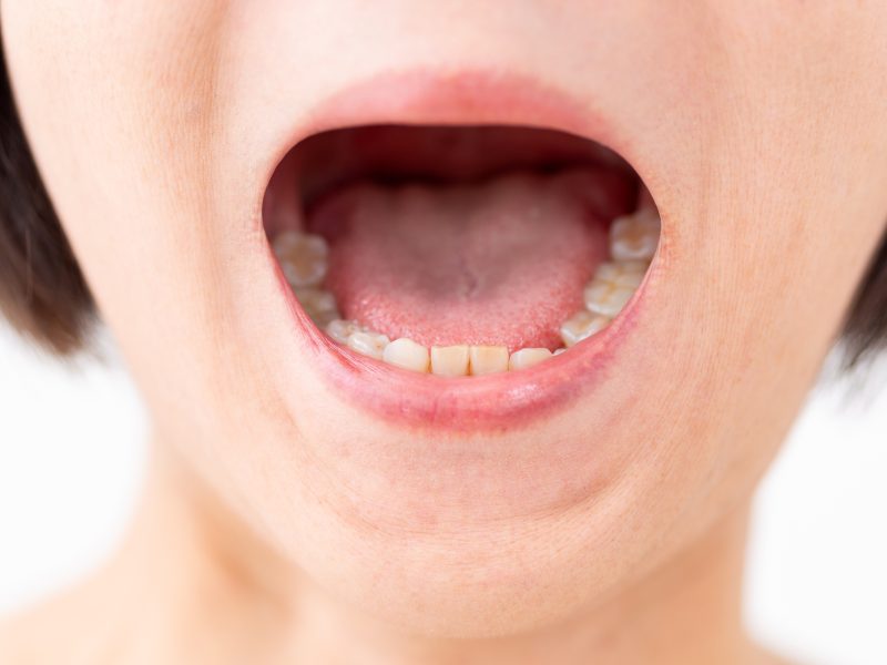 中咽頭がんとは？原因・症状・治療・予後・予防まで徹底解説