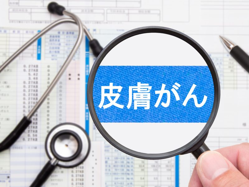 皮膚がんのセルフチェック方法｜ほくろ・シミとの見分け方と受診の目安を解説